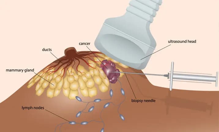 Biopsie zum Nachweis von Krebszellen mit Ultraschall  
