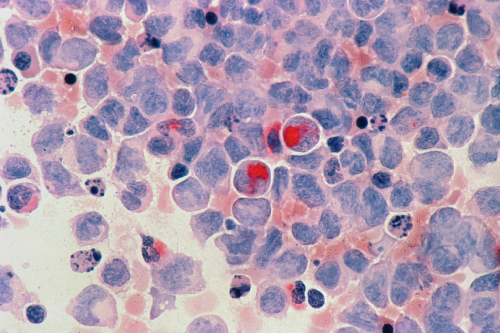 Comprendre le cancer secondaire : Causes, symptômes, diagnostic et options thérapeutiques