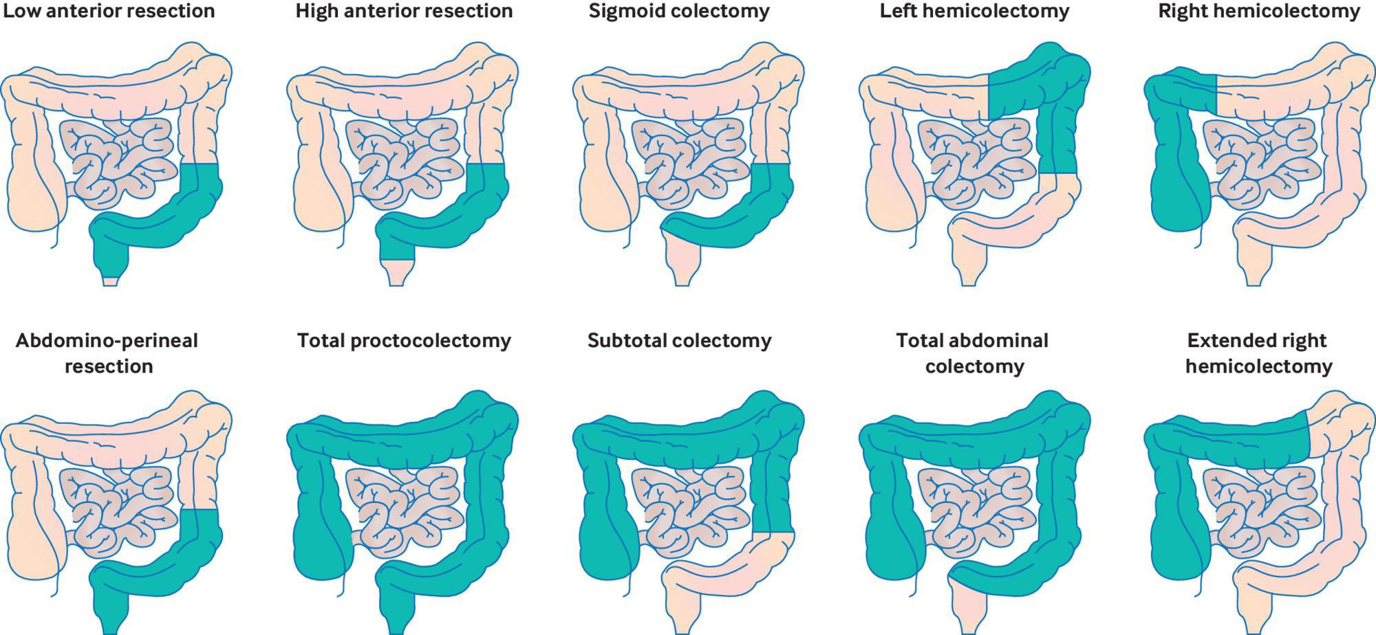 All types of Anterior Resection